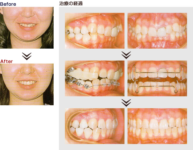 矯正治療 Before After 不正咬合 矯正歯科は西宮市の歯を抜かない非抜歯矯正 噛み合わせ外来 なかの歯科クリニック